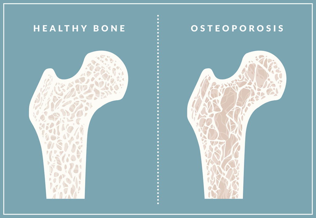 osteoporosis vs healthy bones