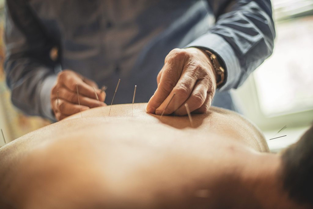 acupuncture for pain relief