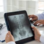 herniated disk