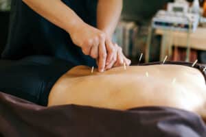 Acupuncture session for back pain