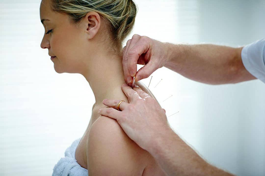 Female patient receiving acupuncture treatment for headaches