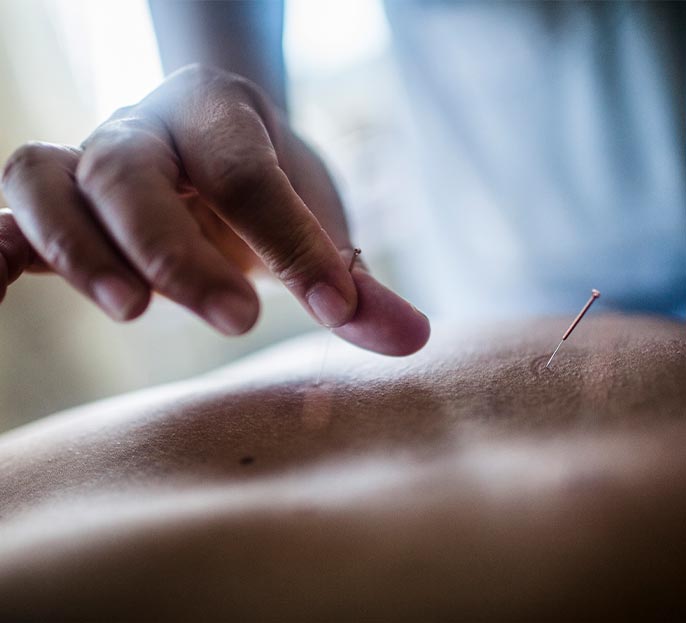 acupuncture